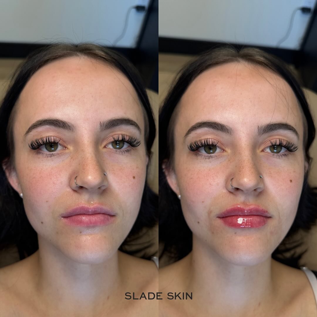A natural lip that enhances your features 

💉Product used: RHA 2 
📍Pleasant Grove Utah