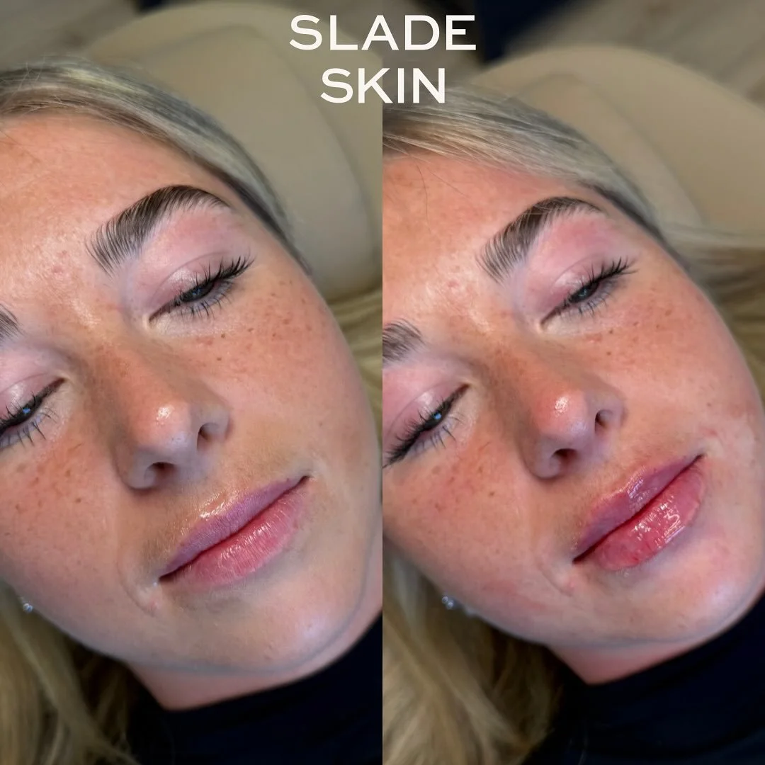 Lip filler is the ultimate cheat code. A tiny bit and suddenly your gloss sits better &amp; your smile feels cuter. 

📍Pleasant Grove Utah 
💉RHA 2