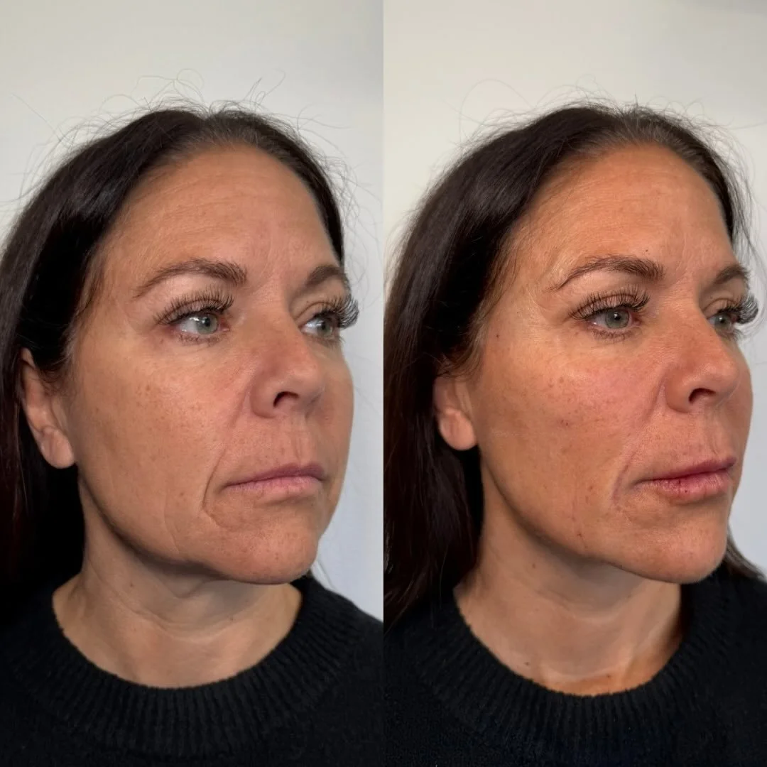 Soft enhancements in the lower face that truly make all the difference. 

- softer smiles lines 
- more sculpted jawline 
- volume replacement 

All without anyone knowing she has filler 🤫

📍Pleasant Grove Utah 

#utahinjector #utahbotox #sladeskin