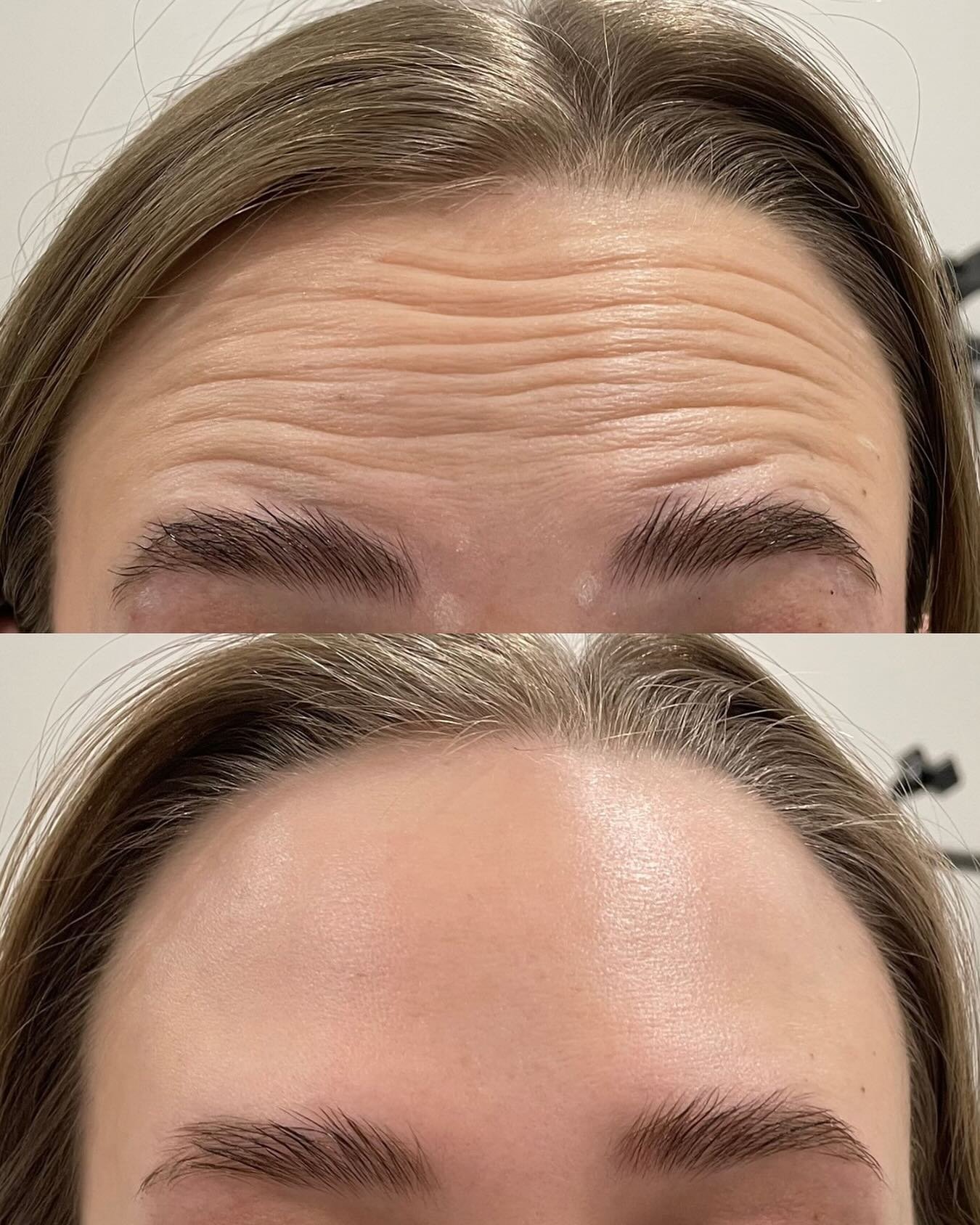 Daxxify is giving ✨smooth, lifted, and lasting✨ results. Think of it as your wrinkle treatment that actually keeps working up to 6 months of confidence with one treatment 💉

📍Pleasant Grove Utah 

#utahinjector #utahnurse #pleasantgrove #daxxify #w
