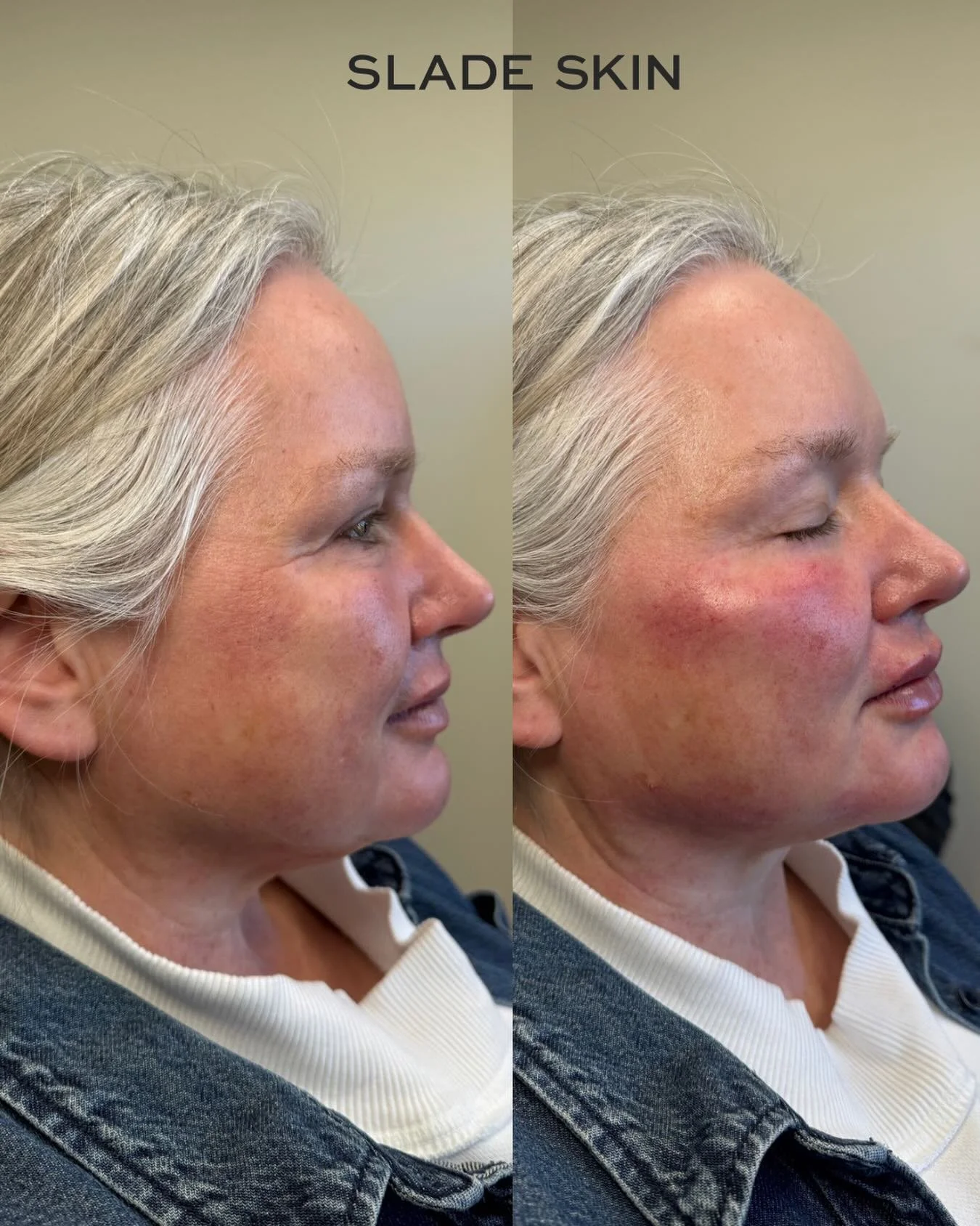 This is what mid-face support does 👏

Cheek filler helps lift the face upward, which can soften the appearance of crow&rsquo;s feet and under-eye lines by improving structural support

#utahinjector #utahfiller #pleasantgrove