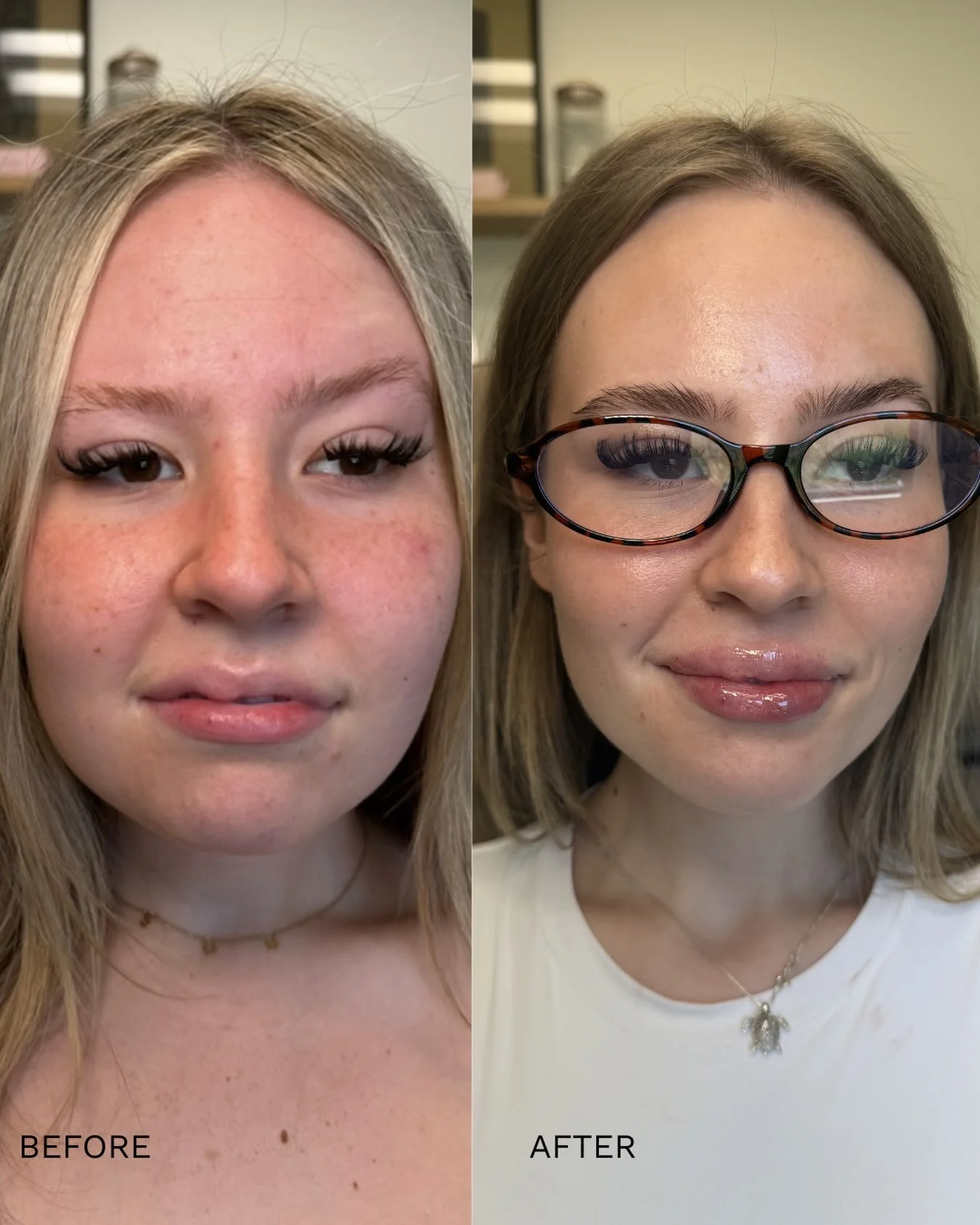 This transformation deserves a spotlight ✨

When she first came to me, one of her biggest concerns was a scar in her upper lip that created asymmetry and made her feel self-conscious about her smile. 

Fast forward to TWO lip sessions over the last y