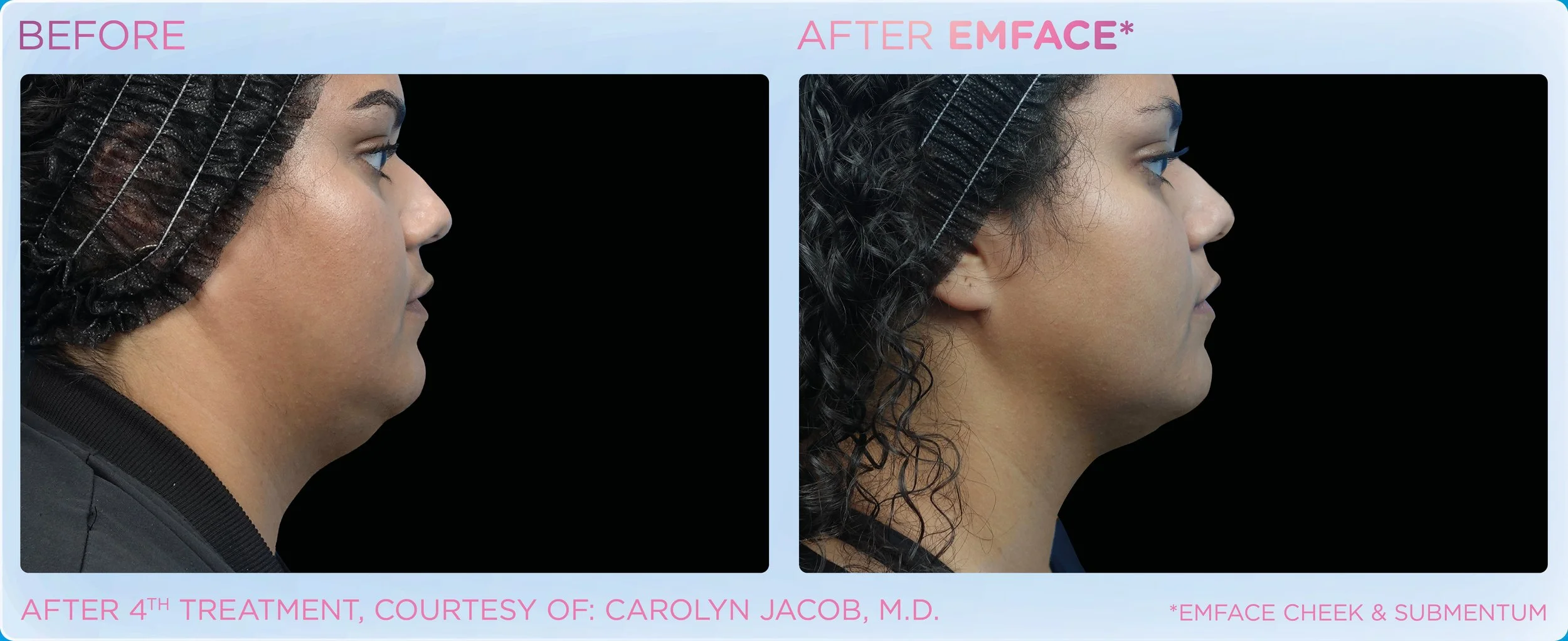 Side-by-side comparison photo showing a person's profile before and after an EmFace treatment. The "before" image shows a less defined jawline and a double chin, while the "after" image shows a more contoured jawline and reduced chin fullness.