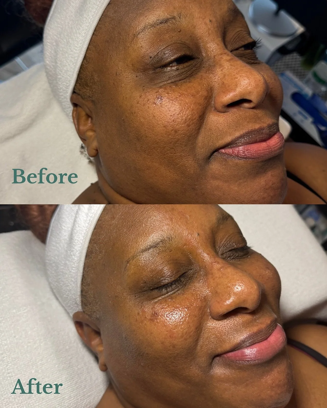 Real skin. Real results.

No filters. No harsh lighting ✨

This before &amp; after shows the results of a gentle microdermabrasion treatment focused on smoothing texture and refreshing dull skin &mdash; without irritation.

My client completed a seri