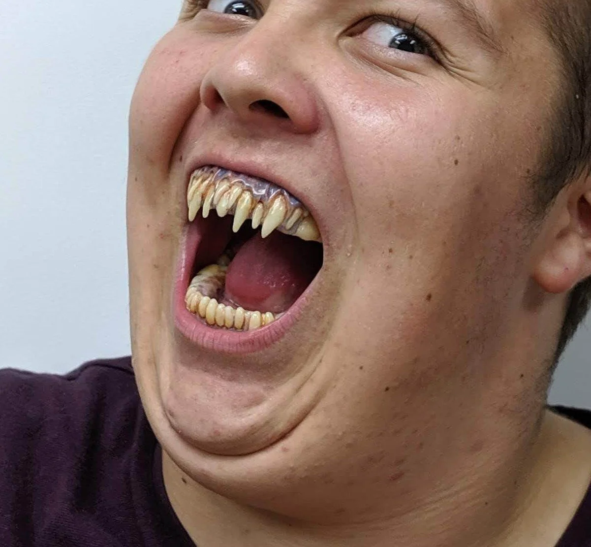 Close-up of a person with unusual and exaggerated vampire-like teeth, showing fangs and a wide open mouth.