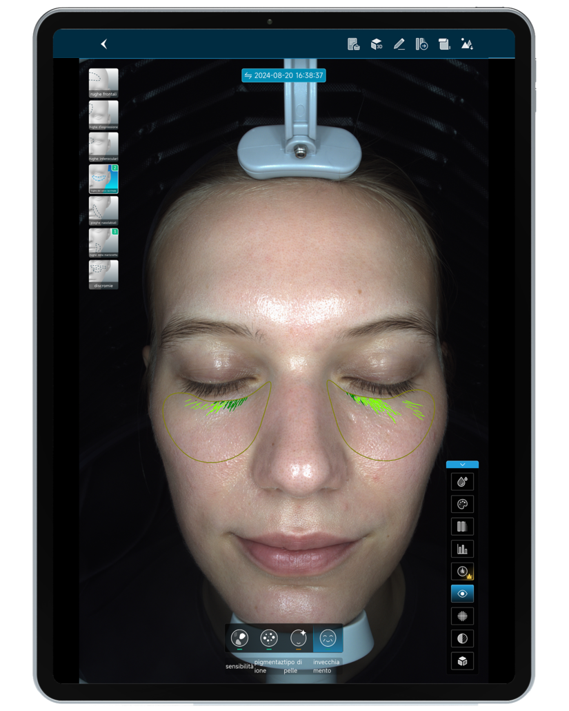 Schermo di un dispositivo che mostra un'analisi del volto di una donna con evidenziazioni delle linee di ruga sotto gli occhi, in un ambiente clinico o di analisi della pelle. Skint Testo Evo Hint.