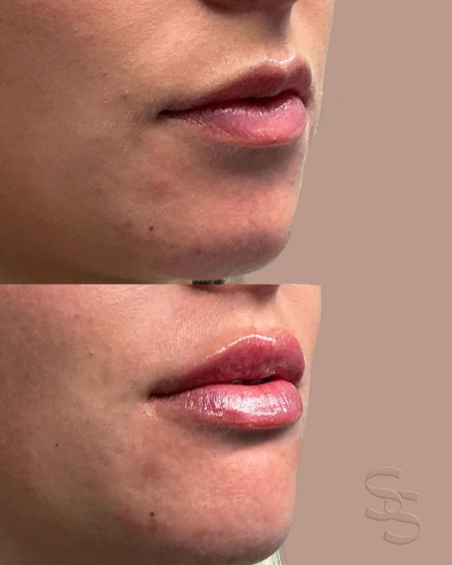 Dermal filler top-up on my gorgeous client ✨
A subtle refresh to enhance hydration, shape, and natural balance.

Dermal filler injections are Medical devices for the treatment of loss of volume in the skin. Dermal fillers have risks and benefits. Ask