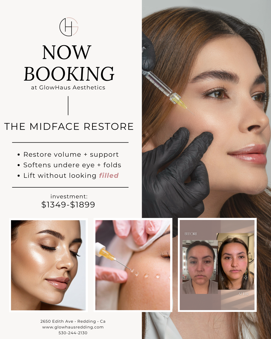 Midface Restore dermal filler treatment showing improved cheek volume, softened under-eye hollowness, and natural facial lifting results at GlowHaus Aesthetics in Redding, California.