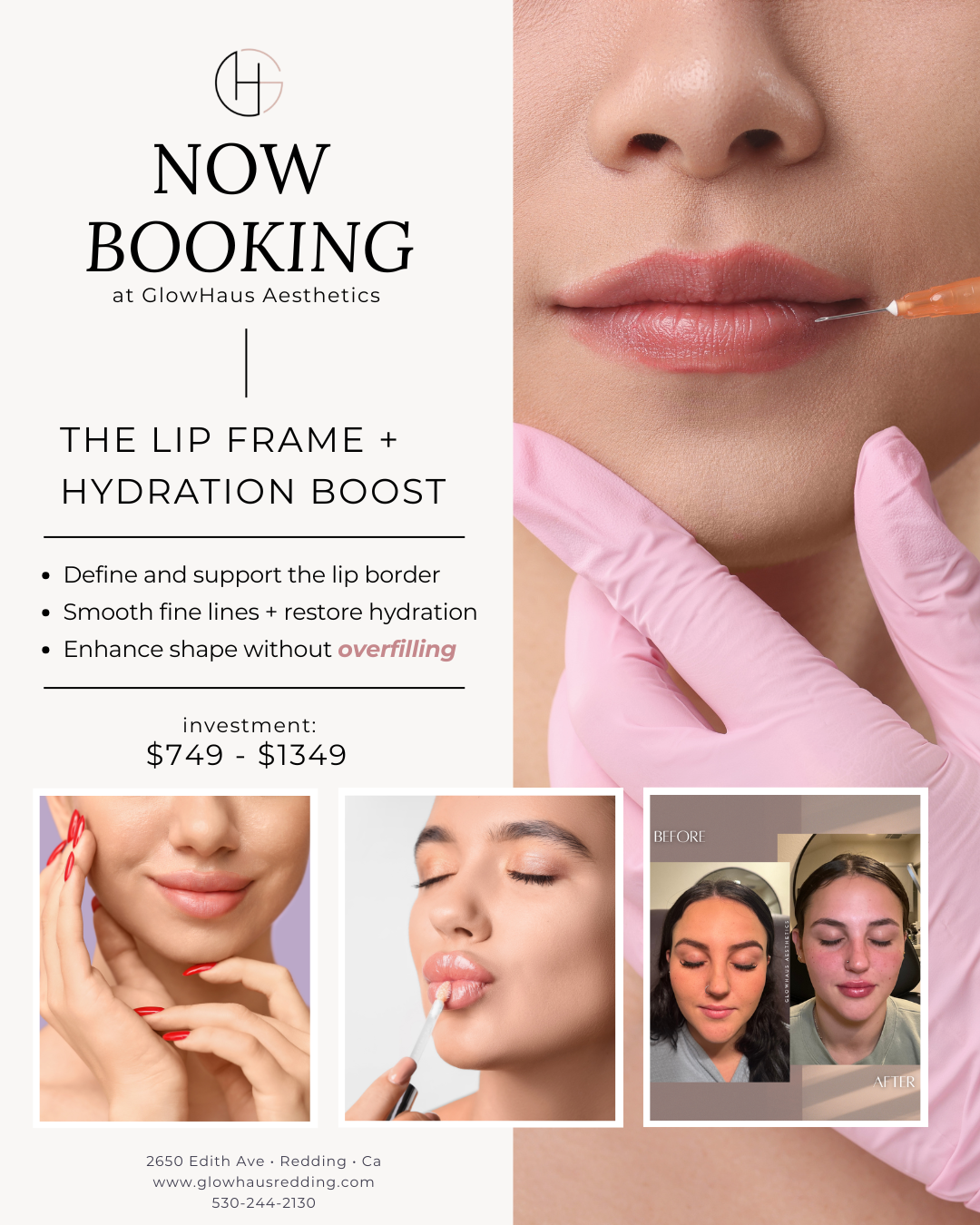 Lip Frame + Hydration treatment showing enhanced lip shape, improved symmetry, and hydrated, natural-looking lips at GlowHaus Aesthetics in Redding, California.