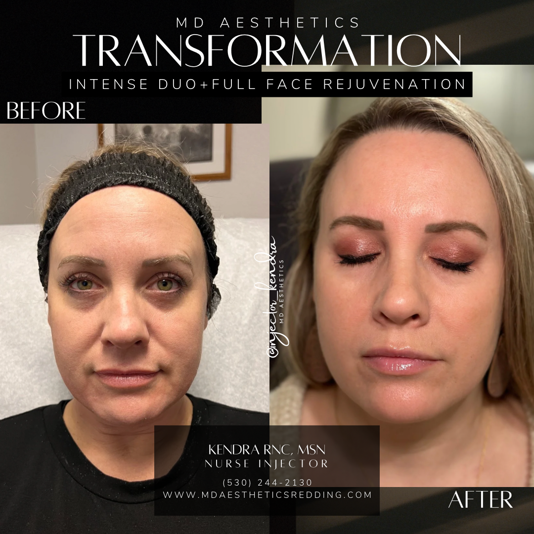 Intense Duo + Liquid Face Rejuvenation + Toxin