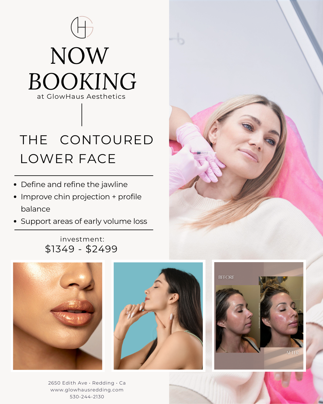 Contoured lower face dermal filler treatment showing enhanced jawline definition, improved chin projection, and balanced facial profile at GlowHaus Aesthetics in Redding, California.