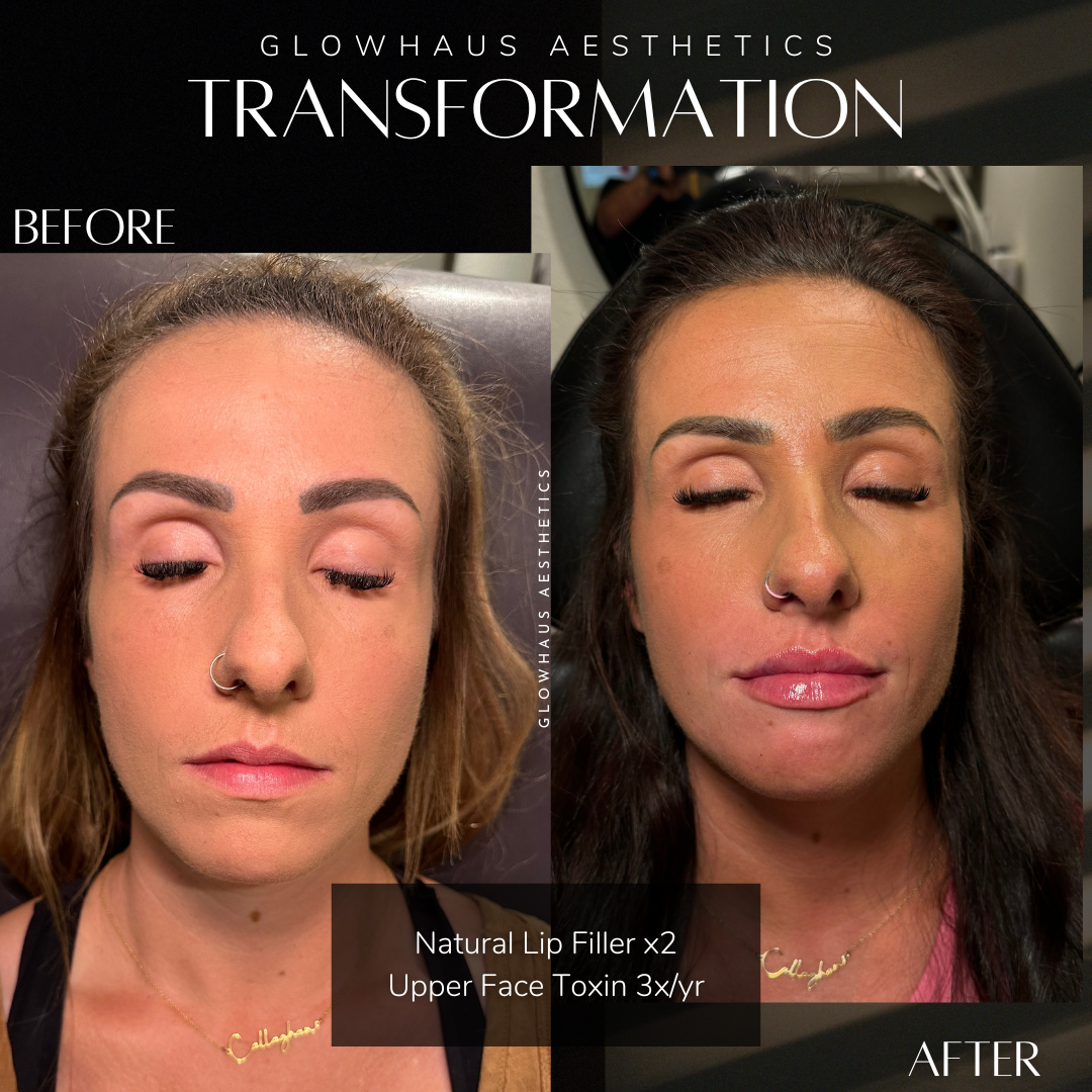 Natural Lip Filler
