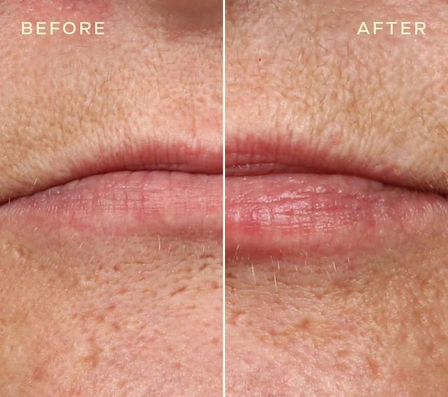 Lip Filler BA 2.jpg