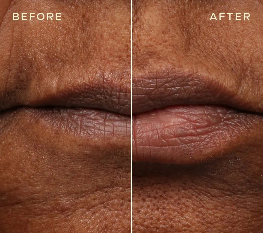 Lip Filler BA 1.jpg