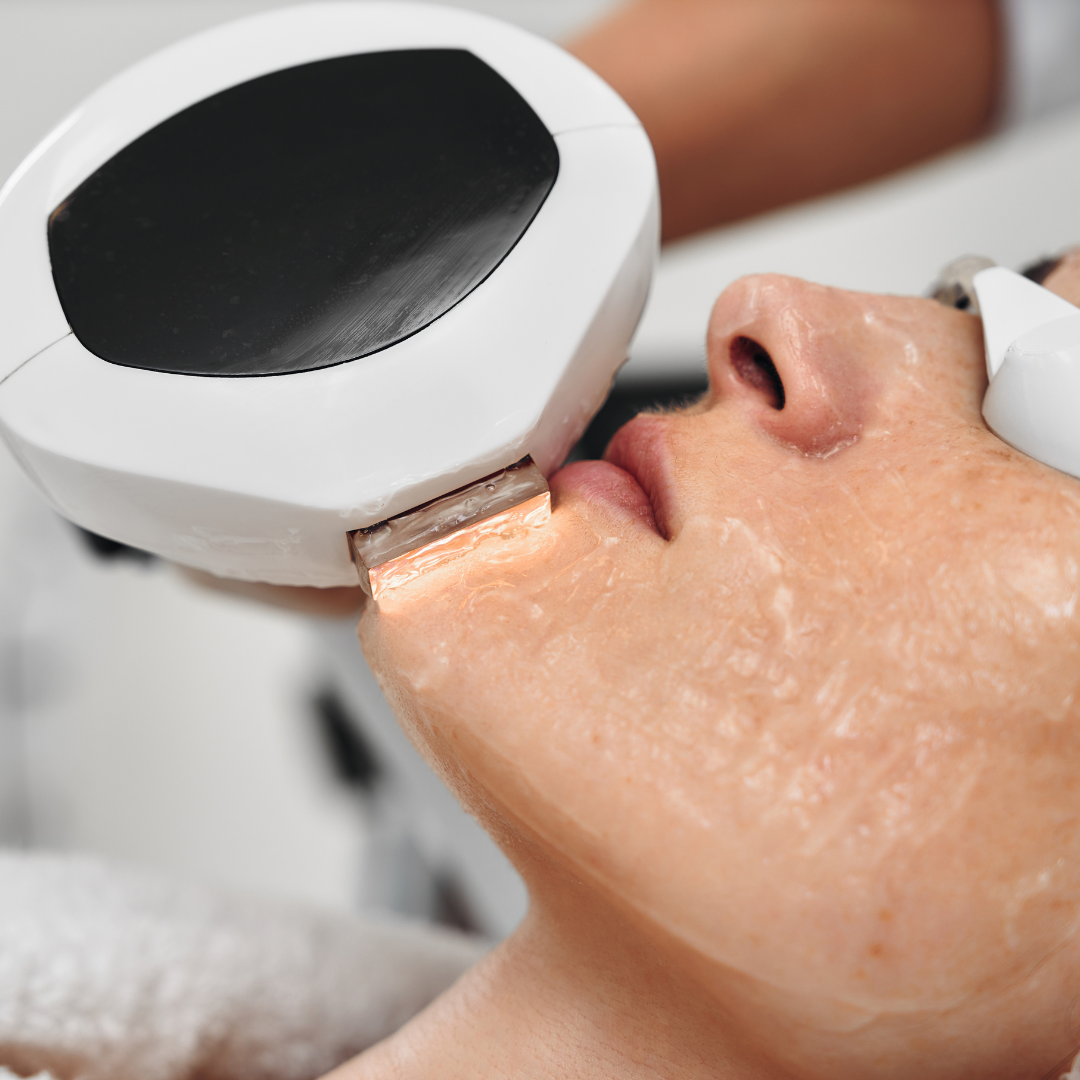 Medspa in Redding, CA 96001 l Lumecca IPL Near Me