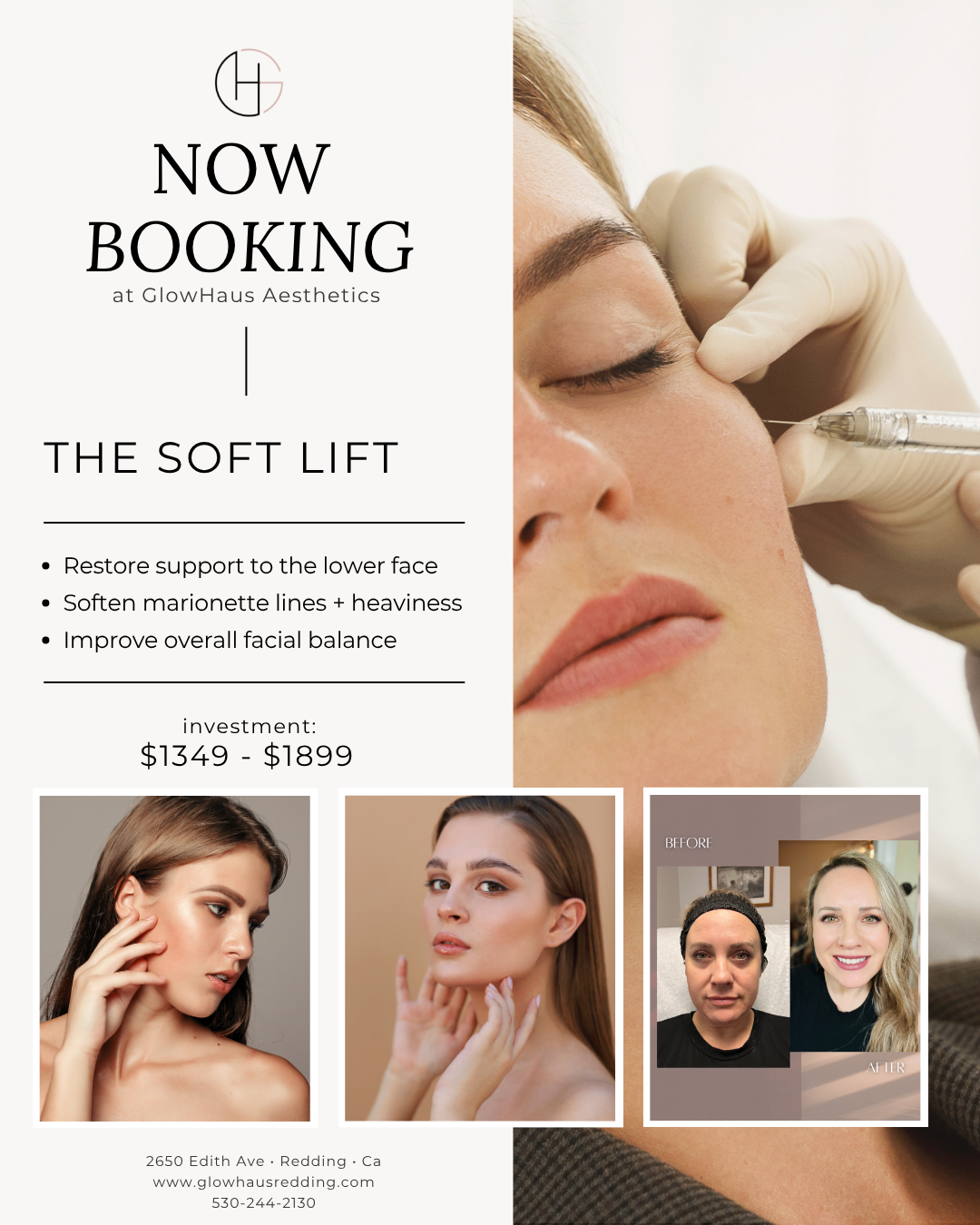 Soft Lift dermal filler treatment showing lower face rejuvenation with improved facial balance, softened marionette lines, and natural looking results at GlowHaus Aesthetics in Redding, California.