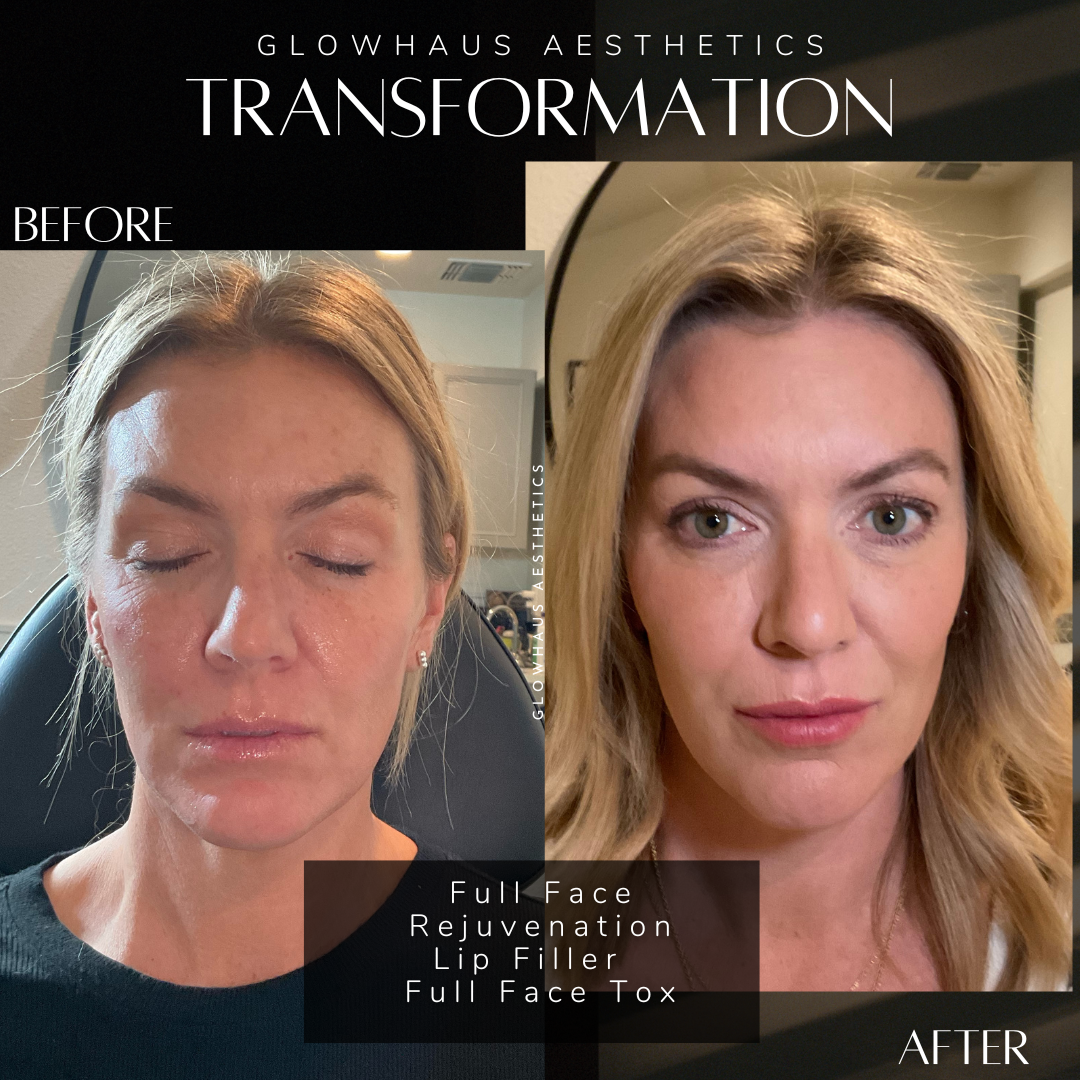 Liquid Face Rejuvenation