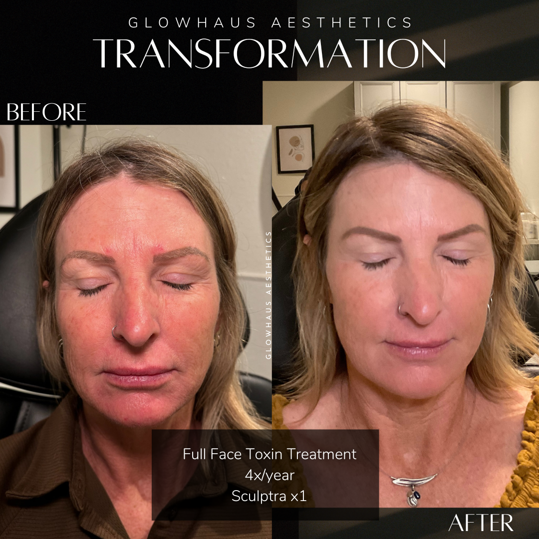 Michelle Toxin + Sculptra B&A.png