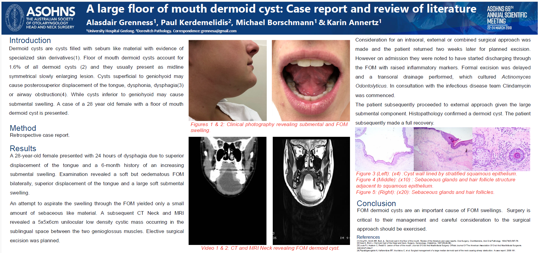 A large floor of mouth dermoid cyst: case report and review of literature