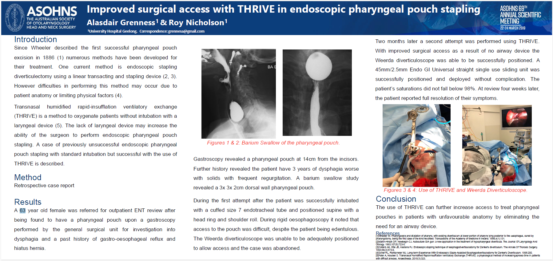  Improved surgical access with THRIVE in endoscopic pharyngeal pouch stapling.