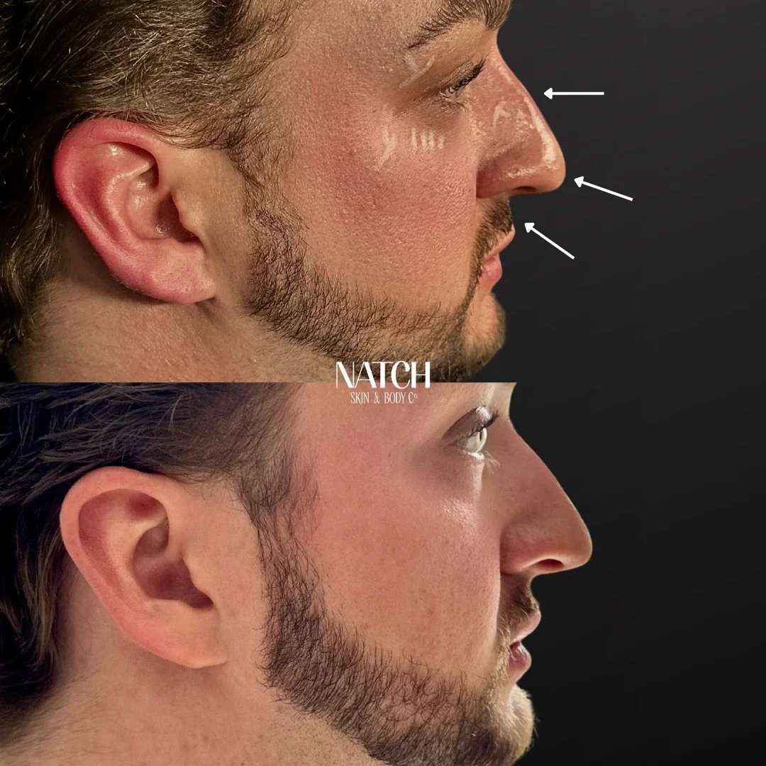 💉 Toxin for Nose Enhancement &mdash; Subtle, Smart &amp; Non-Surgical 💉

👃🏽 You&rsquo;ve heard of toxin (such as B&rsquo;tox or Xeomin) being used in numerous different areas, BUT, did you know we can strategically transform the nose safely? 

At