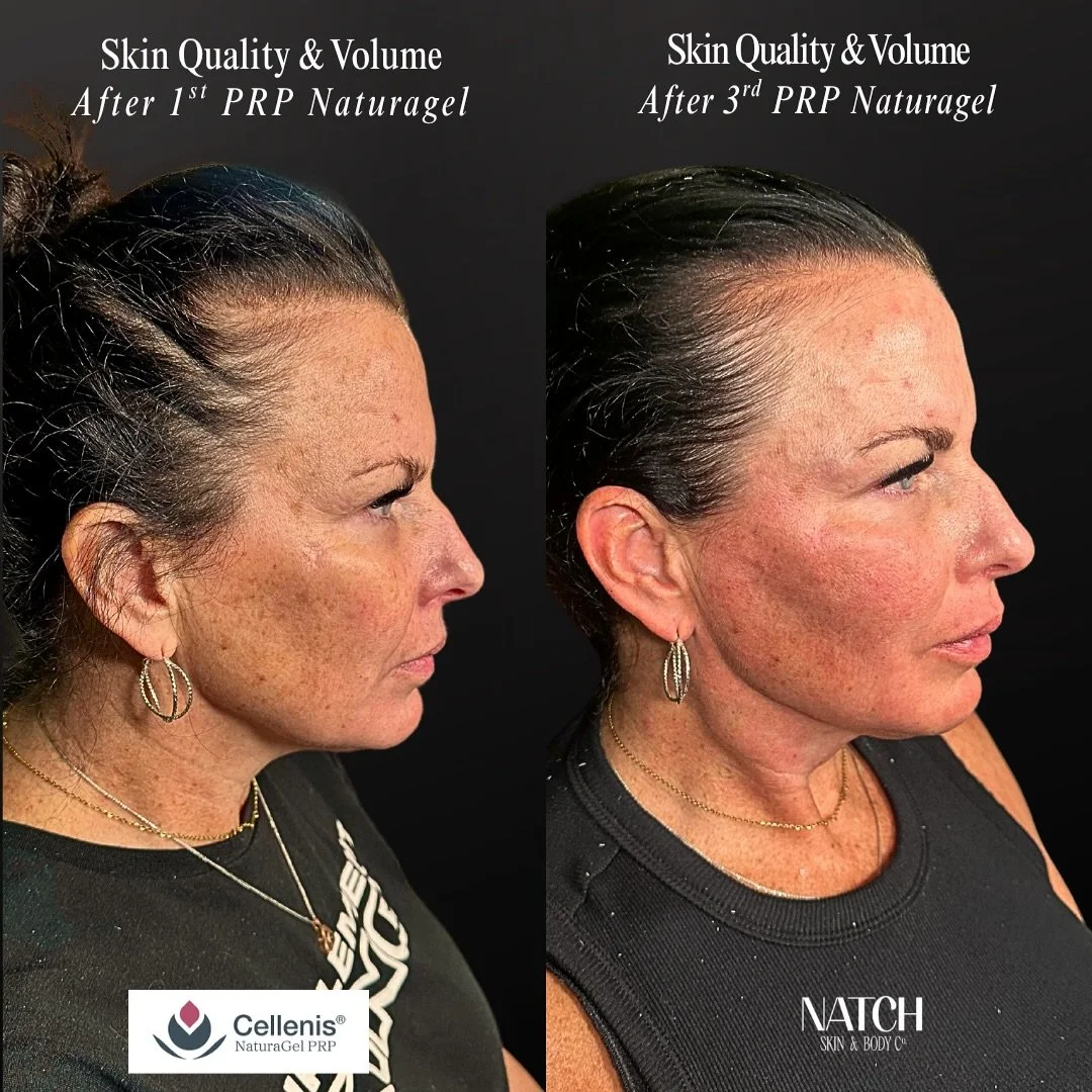 💉 Natural rejuvenation at its finest! 💉

✨ Look at this incredible difference from before her first PRP Naturalgel treatment to after her third. 

✨ We&rsquo;re celebrating the significant improvements in her skin&rsquo;s texture and glow, enhanced