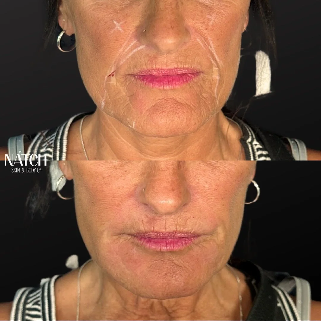 💉 DEMAND MORE FROM YOUR FILLER - EXPECT VOLUME &amp; BIOSTIMULATION 💉

👉🏼 While traditional fillers address the symptom of volume loss, Radiesse goes further by tackling the underlying cause of aging &ndash; the depletion of collagen and elastin.