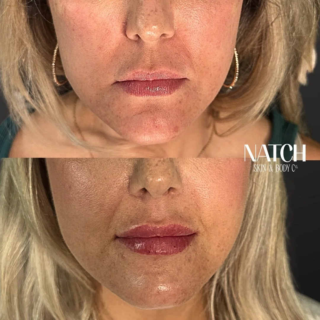💉 LOVELY LIPPIES 💉

👄 Summer has our hair up, faces natural and glowy and our lips are the main character of subtle enhancements. 

🫦 BUHBYE are the days of overfilled, shapeless lip filler - natural, &ldquo;barely there&rdquo;, strategically pla