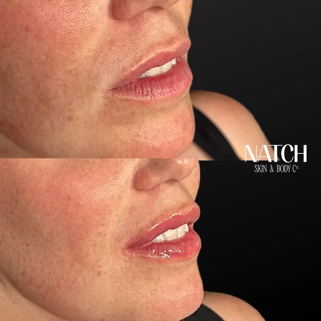 💉 &ldquo;Lip Balm Filler&rdquo; - Pardon Moi? 💉

💧 Hyaluronic acid (HA) fillers are a popular treatment not just for adding volume to the lips, but also for improving hydration. This is because hyaluronic acid has a remarkable ability to attract a