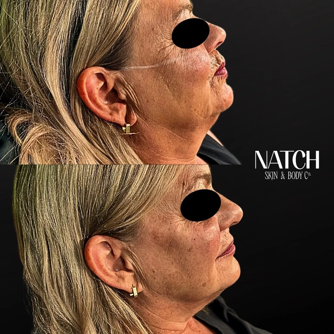 💉 INJECTABLE EXPECTATIONS 💉

&mdash;Setting realistic expectations with injectables is key! 🔑 

&mdash; Did you know one syringe is 1cc, and a small ketchup packet holds 8cc? 

&mdash; For skin laxity or significant volume loss, truly impactful re