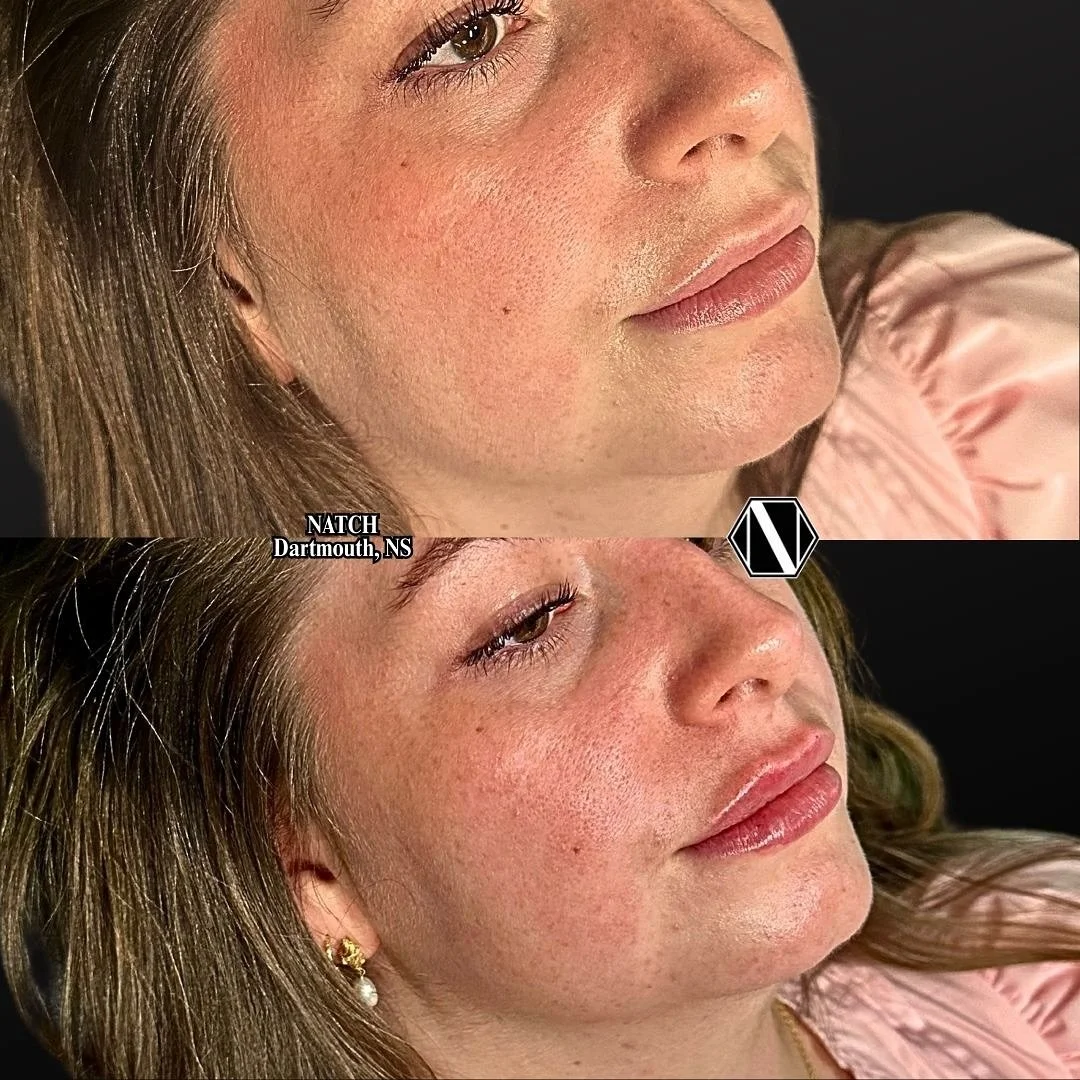 💉 Lips Only Fit For A Princess 👑 

✨ This is the final stage of this client&rsquo;s lip transformation. 

✨ She originally had uneven, overfilled lips with plenty of migration up into her nasolabial folds. Her natural structures were obliterated.  