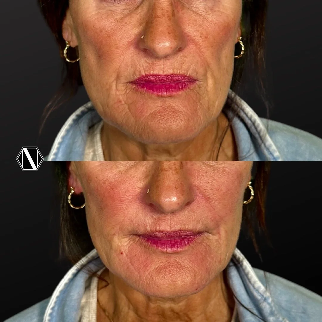 💉 ROUND TWO OF PERI-ORAL BIOSTIMULATION 💉

&mdash; Taking her facial balancing &amp; tissue refreshment to the next level with a 2nd treatment of Radiesse+ 

&mdash; Targeting areas of lost volume, laxity, and deeper lines specifically around her l