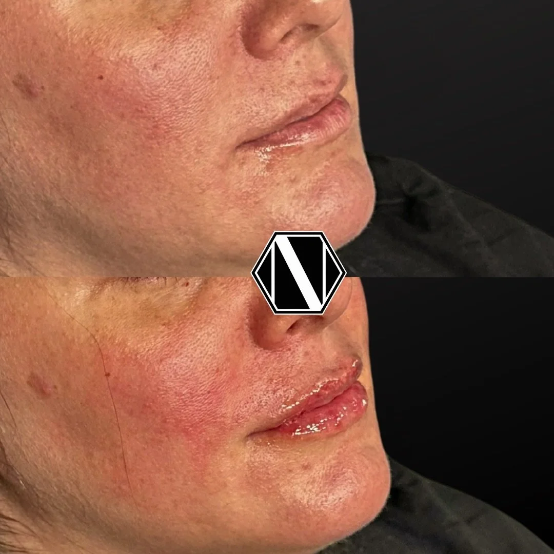 💉 &ldquo;Half or Full Syringe&rdquo; 💉 

✨ WHAT DOES THIS MEAN? 
&bull; Full Syringe: Typically contains 1.0 milliliter (mL) of filler.&nbsp; To put this in perspective, 1.0 mL is about one-fifth of a teaspoon&mdash;a small amount, but potent for t