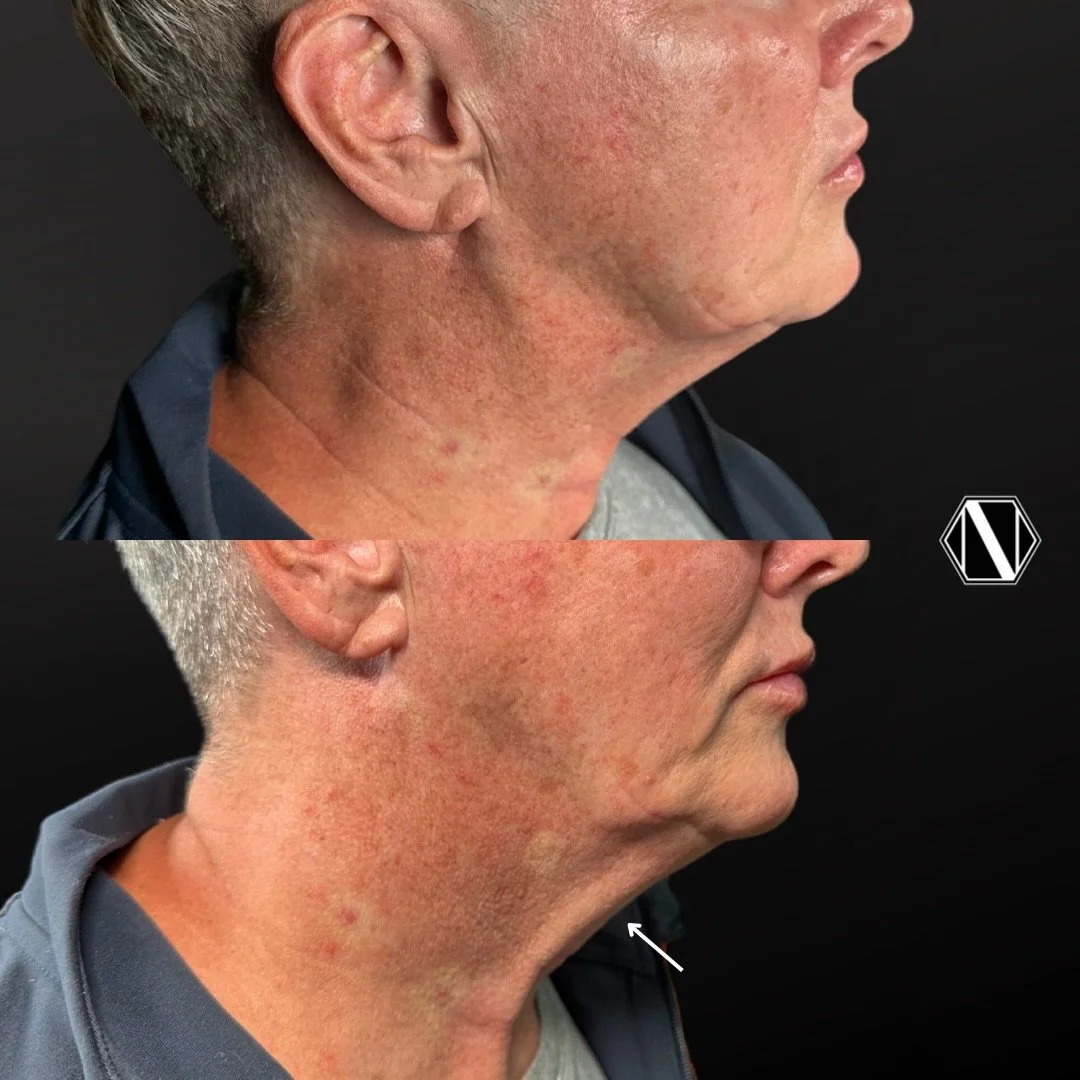 💉 RADIESSE+ FOR NECK: Immediate Results, Progressive Restoration 💉

⚡️ At Natch Restorative Medicine, we use Radiesse to strengthen and smooth the delicate skin of the neck &mdash; not by adding volume, but by stimulating your body&rsquo;s own coll