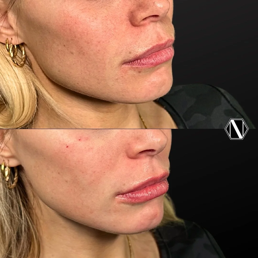 💉 Post-Partum Lip &amp; Facial Changes 💉 

&mdash; This beautiful client is just over 1 year post-partum from her first babe. She noted loss of volume in her lips over the last year. 

💋 Lips
&mdash; Loss of volume and hydration: Estrogen levels p
