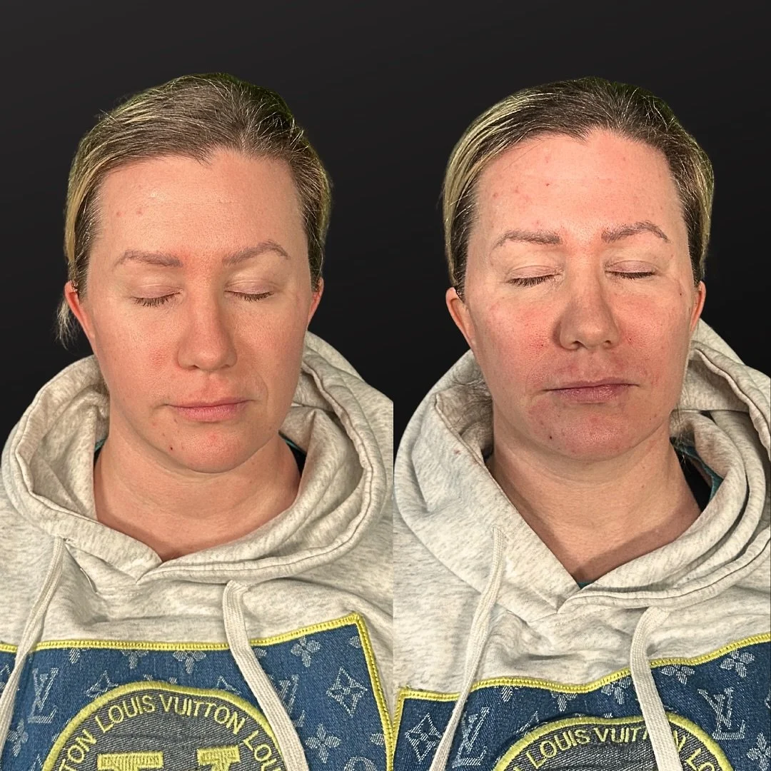 💉 Hyperdilute Radiesse+ for Youth Preservation 💉

&mdash; Hyperdilute Radiesse is an advanced technique used for facial rejuvenation that focuses more on skin quality and texture rather than just deep volume replacement

&mdash; Mechanism: Like reg