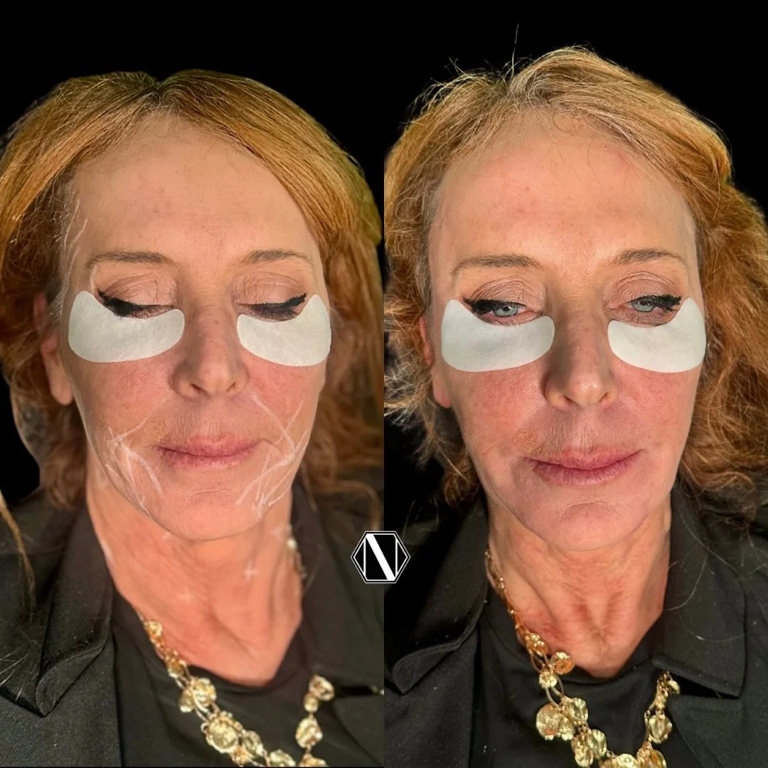 💉 HYPERDILUTE RADIESSE+ FOR FULL FACE BOOST &amp; BALANCE 💉

🧬  This full-face restorative approach allows for high-volume distribution across broad treatment areas, delivering instant, natural-looking volumization paired with powerful biostimulat