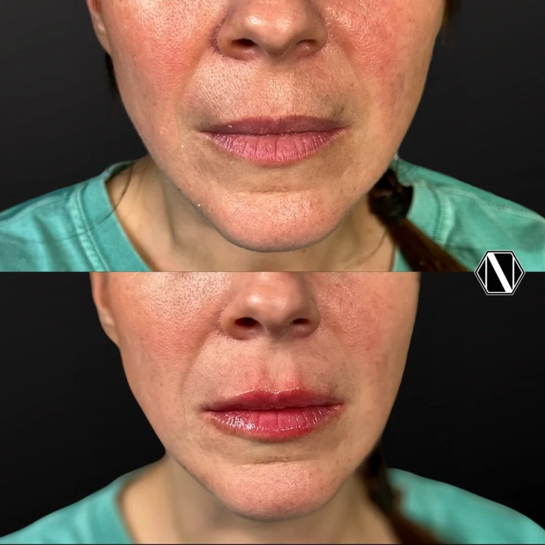 💉 ENHANCING LIPS / SURROUNDING ANATOMY FOR A NATURAL RESULT 💉

💋 To achieve a truly natural and &ldquo;healthy&rdquo; looking lip, we have to respect the existing anatomy, not erase it. 

💋 My approach to customized filler focuses on three key pi