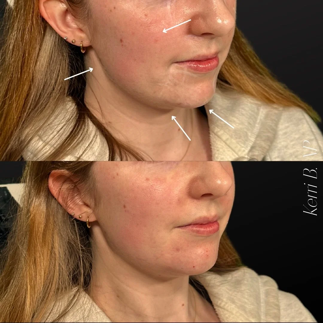 💉 RADIESSE+ FOR RECESSED CHIN AUGMENTATION 💉

1.  Immediate Volume + Collagen Biostimulation (The Dual Action)

&bull; Composition: Calcium Hydroxylapatite (CaHA) microspheres suspended in a gel carrier.&nbsp; 
&bull; Mechanism:
 &mdash; Immediate: