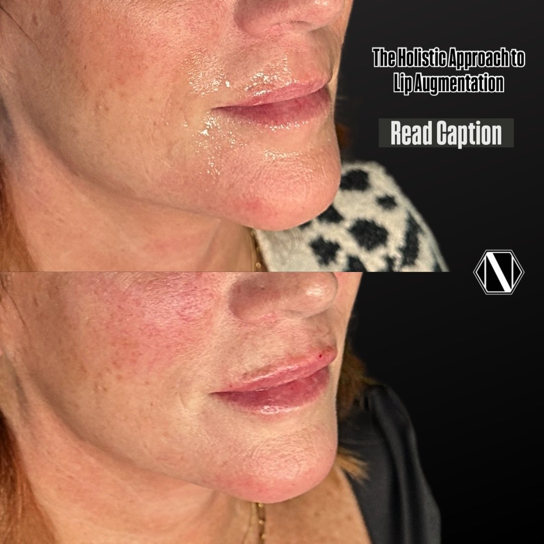 💉The Holistic Approach to Lip Augmentation 💉

1. Perioral Region (The Frame):

Treating perioral lines (smoker&rsquo;s lines) and supporting the oral commissures (corners of the mouth) is vital. If the lines are deep, simply plumping the lip can ma