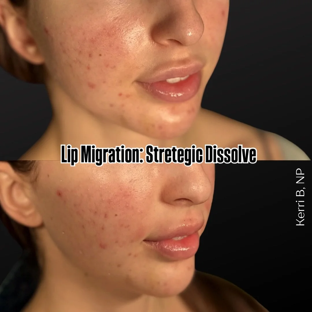 💉 STRATEGIC LIP DISSOLVING: It&rsquo;s not about erasing, it&rsquo;s about refining 💉

💋 Sometimes the most beautiful transformations aren&rsquo;t about what we ADD, but what we TAKE AWAY.

We&rsquo;re moving past &ldquo;full removal&rdquo; and us