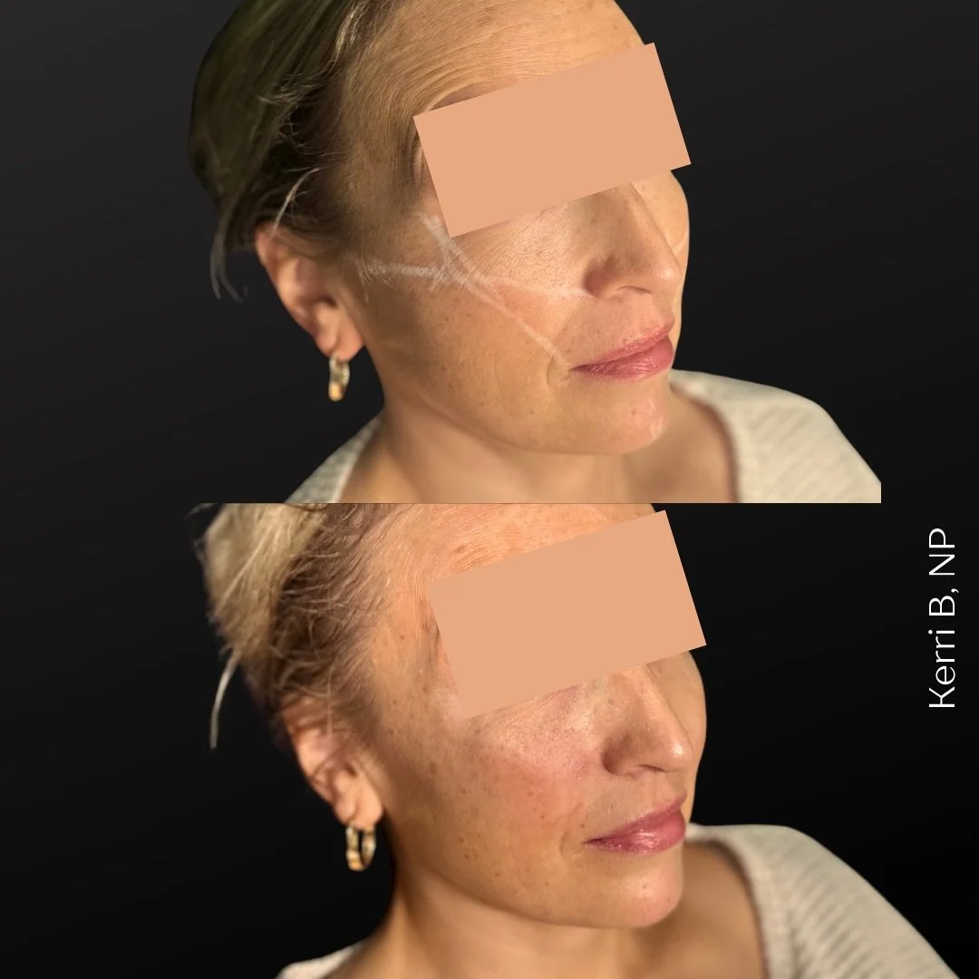 💉 Stop Filling, Start Lifting With the &ldquo;8-Point Lift&rdquo; Technique 🏗️ 💉

✨By treating the face as a structure rather than a map of wrinkles, we use tiny amounts of filler at strategic &ldquo;anchor points&rdquo; to restore your natural sc