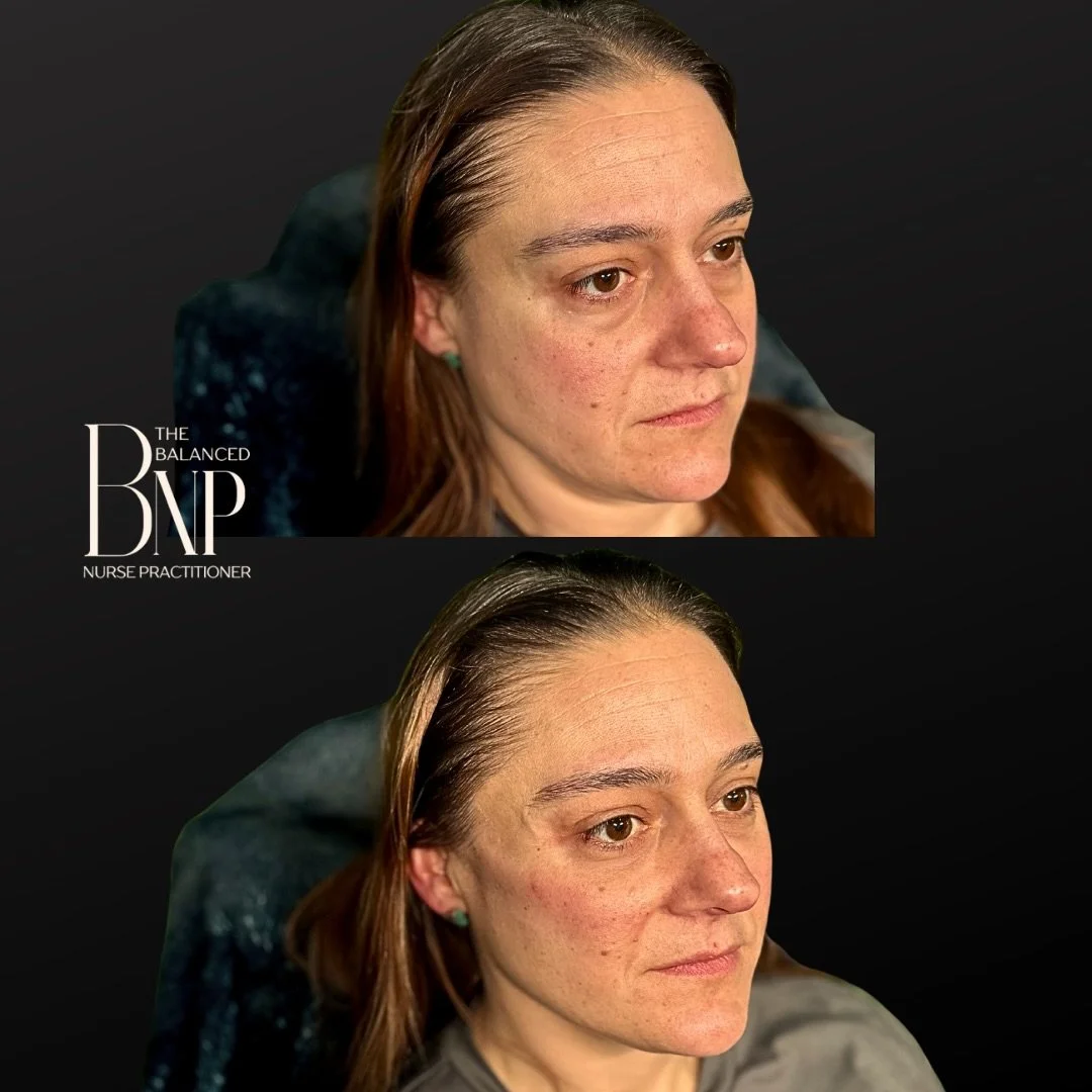 ☀️💉 The Best of Both Worlds: Why Choose Btwn Filler or a Biostimulator When You Can Have Both? 💉☀️

Radiesse is often considered a more &ldquo;powerful&rdquo; or &ldquo;superior&rdquo; option when you want a single product to provide both immediate