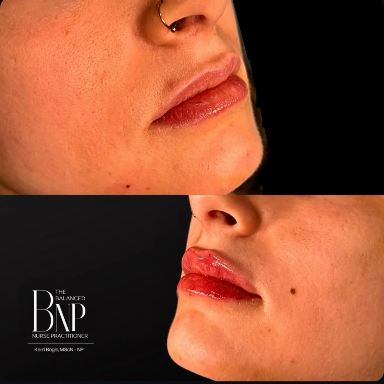 💉 OBVIOUS LIPS ARE OUT.  LUXURY LIPS  ARE IN 💉

💋 Lip filler has a bad rep. Clients instantly associate &lsquo;lip filler&rsquo; with the overfilled look.  Let&rsquo;s call it what it is: poor placement and a lack of injector skills/artistry that 