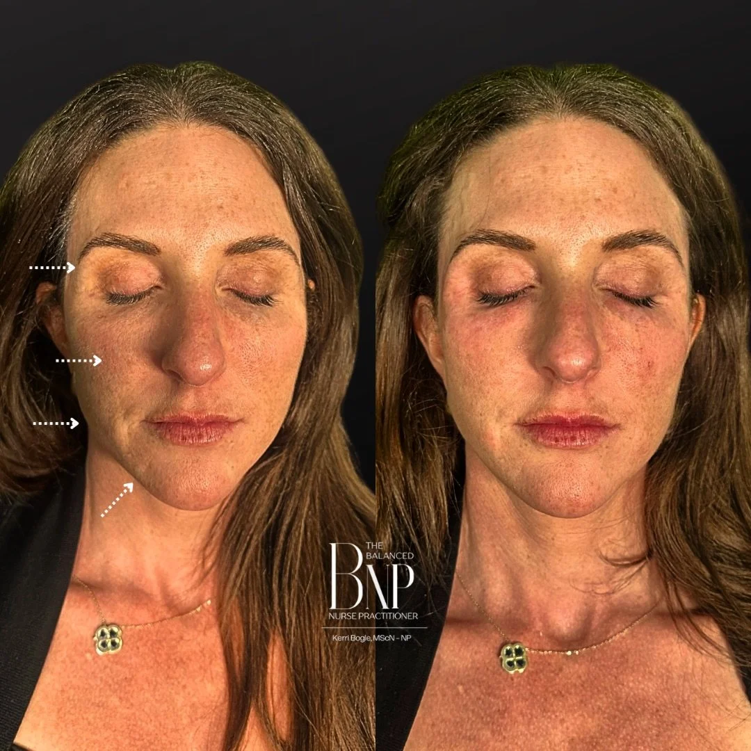 💉 Experience BioFusion&trade; by Dr. Andrew Dargie. 💉

True artistry meets biological science. BioFusion isn&rsquo;t just a treatment; it&rsquo;s a clinical approach to facial balancing &amp; skin tightening using blended HA filler with hyperdilute