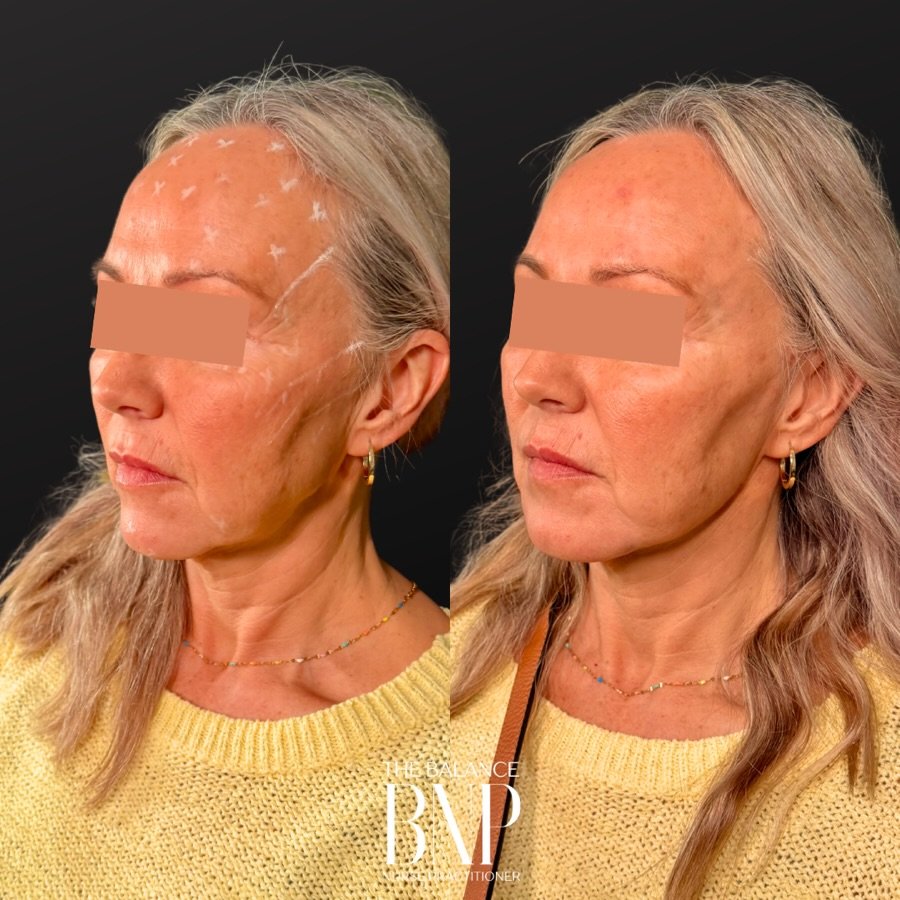 💉 This result? One treatment with Radiesse+ 💉

Hi, I&rsquo;m Kerri&mdash;your East Coast Radiesse &ldquo;go-to&rdquo;👋

If you&rsquo;ve been scrolling through social media seeing &ldquo;puffy&rdquo; faces and &ldquo;pillow-cheek&rdquo; filler, you