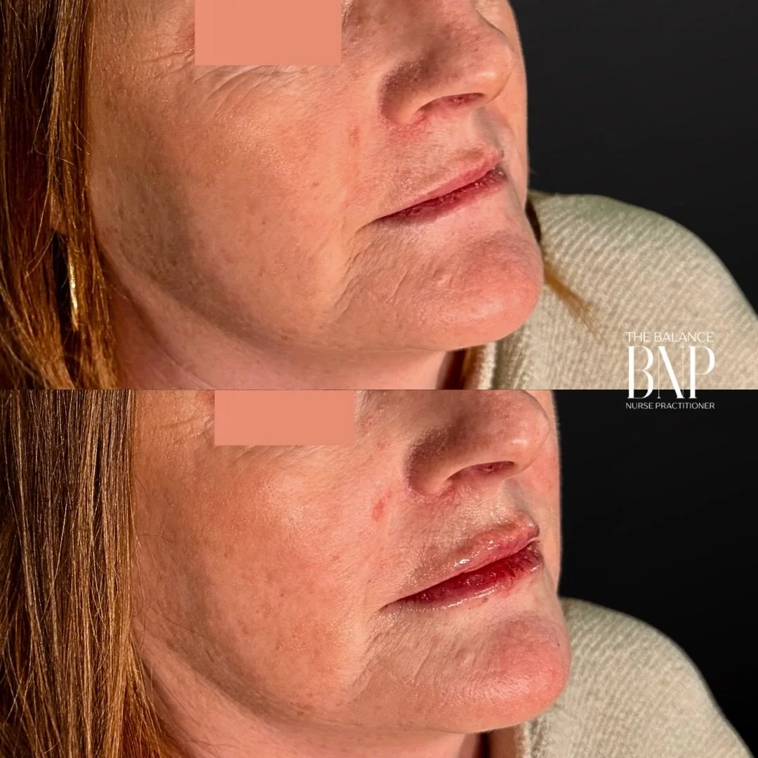 💉 👄The Perioral Complex: Why &ldquo;Just Filler&rdquo; Isn&rsquo;t Always the Answer 👄 💉

When we look at a rejuvenation of the mouth, we aren&rsquo;t just looking at the lips - we are looking at the entire perioral complex. 

In this transformat