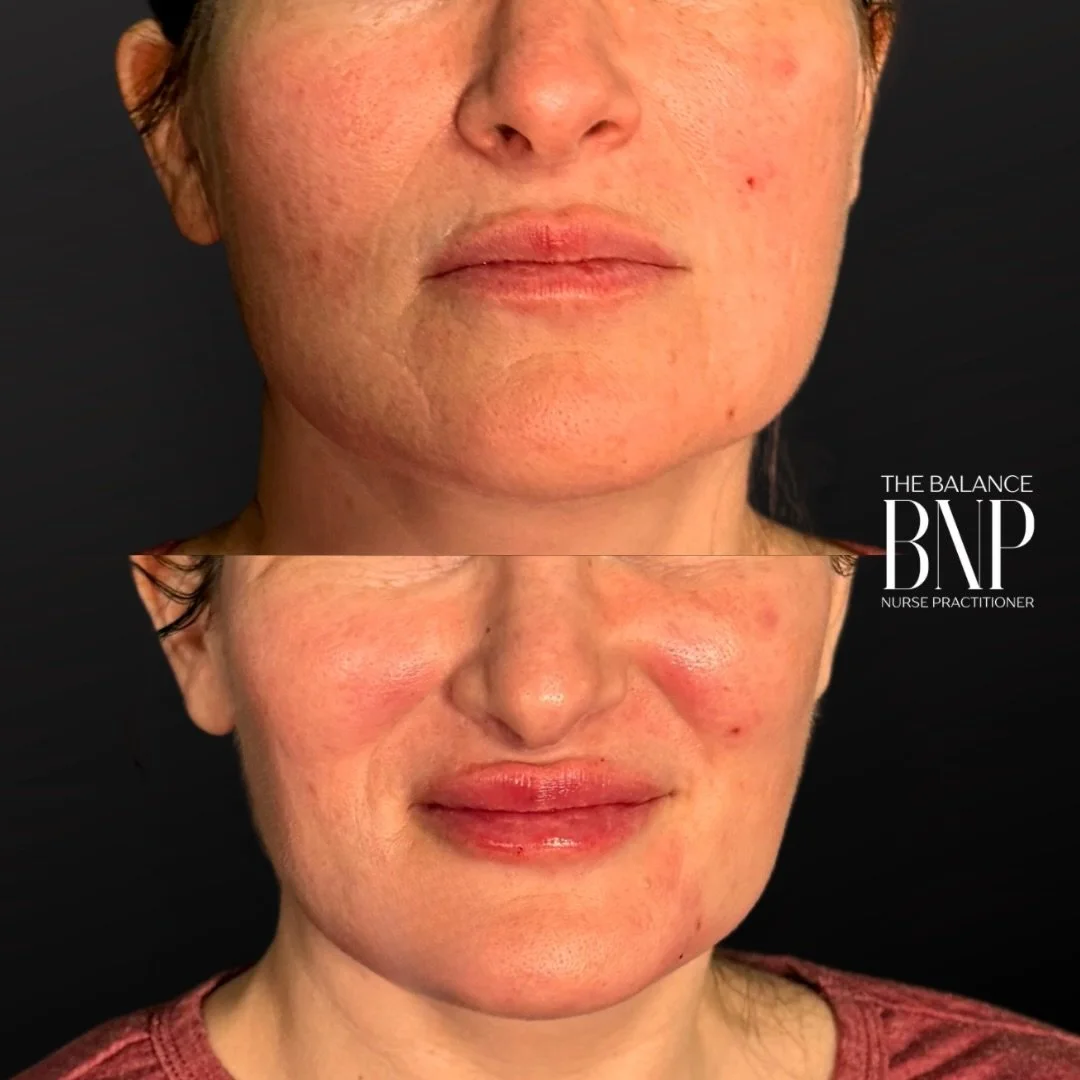 💉 PERIORAL REFRESH 💉

The perioral region is most easily identified as the area around the mouth! From the bottom off of the nose to chin 🌷

This treatment included:
1️⃣ Removing old lip filler from areas we don&rsquo;t want it. As older filler br