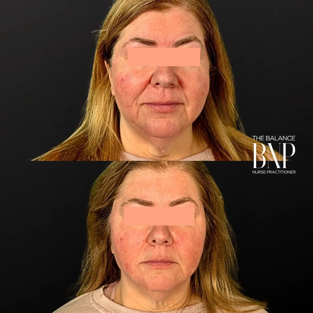 💉 Weightloss &amp; Radiesse+✨ 💉

Weight loss is a win for the body, but it can leave the skin feeling a little &ldquo;deflated.&rdquo; For this patient, we used 2 syringes of Hyperdilute Radiesse to treat the lower face and neck.

Unlike traditiona