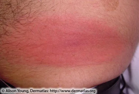 Lyme Rash no clearing